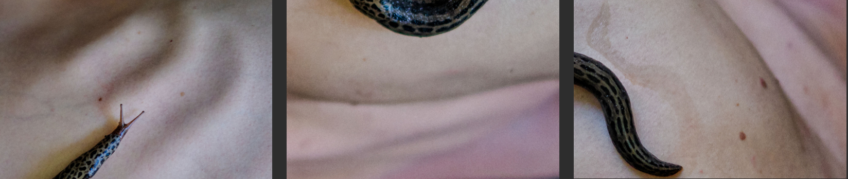 snails on human skin